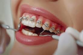 Orthodontic Care